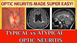 OPTIC NEURITIS  Typical optic neuritis and atypical optic neuritis [upl. by Nations]