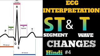 ECG interpretation in hindi  how to read ecg in hindi  ST and T Wave Changes interpretation  4 [upl. by Hescock]