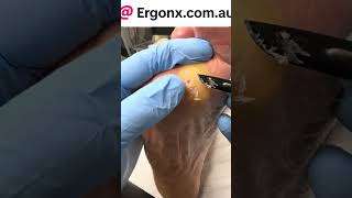 Forefoot callus removal in podiatry clinic [upl. by Magdau403]