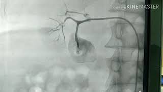 Renal artery coilingembolization [upl. by Infield]