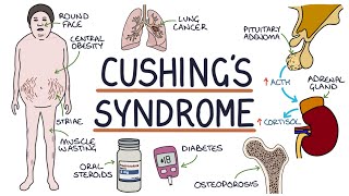 Understanding Cushings Syndrome [upl. by Aretha]