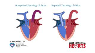 Tetralogy of Fallot Repair [upl. by Aohsoj171]