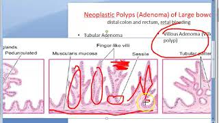 Pathology 521 g Neoplastic polyp tubular adenomatous villous papilloma tubulovillous papillary [upl. by Carly]