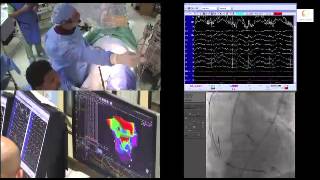 VT ablation with 3D electro anatomical mapping in a patient with VT storm and multiple CRTD shocks [upl. by Dudley]