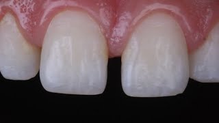 diastema closure with composite resin [upl. by Aihsekram]