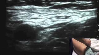 Ultrasound Guided Femoral Nerve Block  SSRAUSAcom [upl. by Dickens]