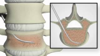 Confidence vertebroplasty [upl. by Roche]