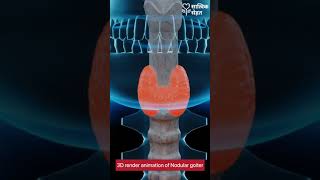 3D render animation of Nodular Goiter  Thyroid Problem [upl. by Ferreby]