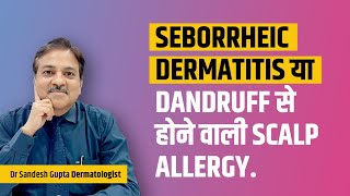 Seborrheic dermatitis या Dandruff से होने वाली scalp allergy Dr sandesh Gupta 9990804085 [upl. by Lorsung]