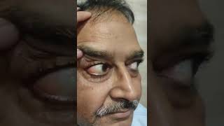 conjunctival cyst conjunctiva eyeball kripanandkumar neet ophthalmology [upl. by Colyer]