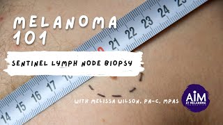 Sentinel Lymph Node Biopsy [upl. by Gram]