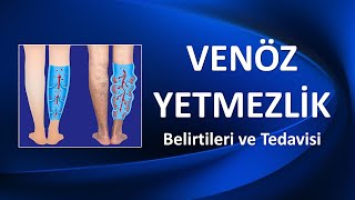 VENÃ–Z YETMEZLÄ°K Belirtileri ve Tedavisi [upl. by Jarrow]