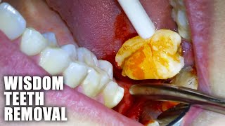 Full Wisdom Teeth Removal Procedure Emergency Extraction of Impacted amp Partially Erupted Molar [upl. by Anaeg555]