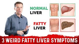 3 Weird Signs amp Symptoms Of Fatty Liver – DrBerg [upl. by Lewie]