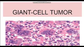 Giant Cell Tumor Morphology Pathogenesis [upl. by Rabi70]