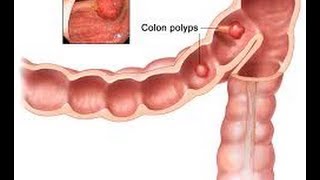 What is a Colon Polyp  Los Angeles Colonoscopy [upl. by Abbotsen364]