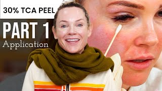 Part 1 How to use TCA peel at home [upl. by Claybourne]