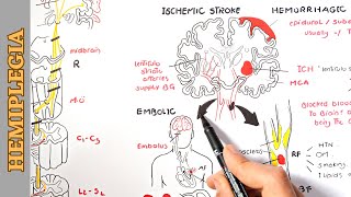 Hemiplegia part 1  causes pathophysiology stages and manifestations [upl. by Naej413]