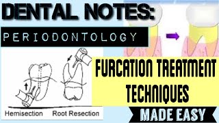 FURCATION INVOLVEMENT PART2 II DENTAL NOTES II PERIODONTOLOGY II TREATMENT PROCEDURES MADE EASY [upl. by Coke]