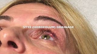 Draining a Stye Hordeolum on the left eye [upl. by Summer275]