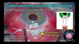 CataractCoach™ 2268 trabeculectomy assisted with Prolene suture [upl. by Anhaj194]