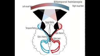 Lesion at the Optic chiasma and Bitemporal Heteronymous Hemianopia [upl. by Eelsha]