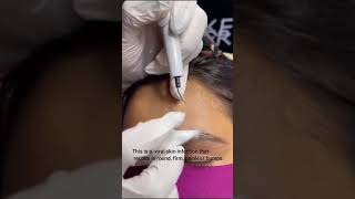 MOLLUSCUM CONTAGIOSUM REMOVAL by Dd Ayesha Faizan mollusca nagpurdermatologist [upl. by Amathiste124]