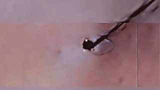 Removal of ingrown hair [upl. by Fannie95]