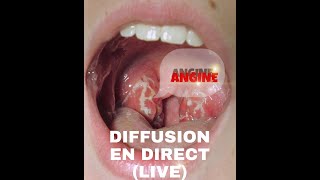 ANGINE QUESTIONS ET REPONSES Diffusion en direct  Dr Toure [upl. by Peggie336]