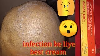 Clobet।GM।Clobetasol Propionate।Clotrimazole And Neomycin Sulphate Cream Review।Sonu Kumar Mishra। [upl. by Baptist]