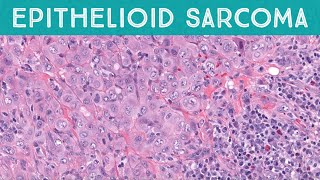 Epithelioid sarcoma explained in 5 minutes pathology dermpath dermatopathology dermatology [upl. by Eanar]