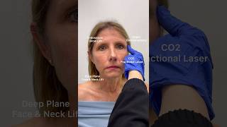 Facelift transformation 🤩 faceliftexpert nycplasticsurgeon nycfacelift njfacelift plasticsurg [upl. by Kcirdorb]