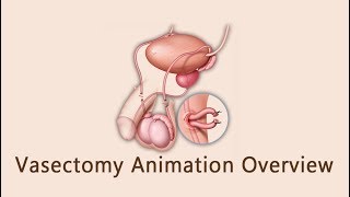 Vasectomy Animation Overview [upl. by Christiana]