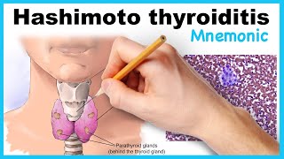 Hashimoto thyroiditis Mnemonic [upl. by Harbour]