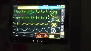 Ventricular Bigeminy [upl. by Idrahs]