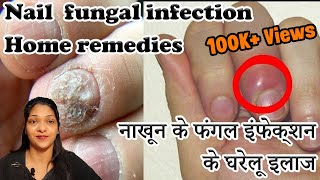 Paronychia Treatment Home Remedies In Hindi finger infection home remedy \nail fungus treatment [upl. by Aneladdam]