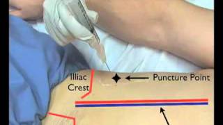 Paracentesis Ultrasound Guided EndoGastroHepnet [upl. by Mohandis]