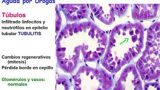 Nefritis tubulointersticial [upl. by Rheta]