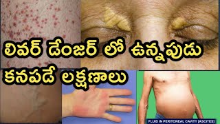 Liver Disease and Symptoms Detailed Video in Telugu [upl. by Hakceber646]