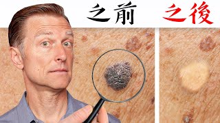 【皮膚】一天快速消除瘜肉和肉疣自然療法柏格醫生 Dr Berg [upl. by Isnam]