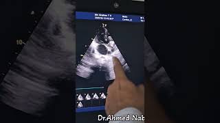 CortriatriatumLarge VSD amp PS 🤔😱 echocardiogram echocardiography heart cardiology heartdisease [upl. by Adniles]