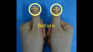 Clubbed thumbs correction [upl. by Oiracam606]