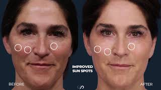 CO2 LASER RESURFACING  FACE amp NECK  DR DAVID STOKER [upl. by Stelmach]