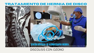 Discolisis Cervical con Ozono en C7T1 [upl. by Ahseuqal]