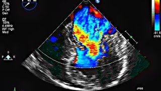 Mitral Valve Prolapse and Mitral Regurgitation  Echocardiography [upl. by Shultz543]