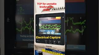 Transcutaneous Pacing for unstable bradycardiaCHB patient emergencymedicine manipalhospitals [upl. by Sinylg]