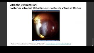 Part 2 Examination of Vitreous and Floaters [upl. by Ssidnak]