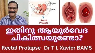 മലാശയം തള്ളി വരുന്നു  Rectal Prolapse Symptoms amp Ayurveda [upl. by Ariad]