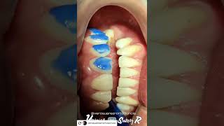 Alineadores INVISALIGN quito ecuador ortodoncistas youtubeshorts shorts [upl. by Gove339]