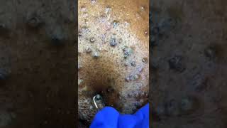 Removing large blackheads and pimples from face new 2021 23 [upl. by Reibaj968]